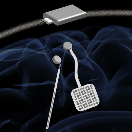 Wireless Neurostimulator Could Offer New Treatment for Parkinson's Disease 