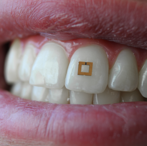 Tooth-Mounted Sensor Offers New Method to Track Diet