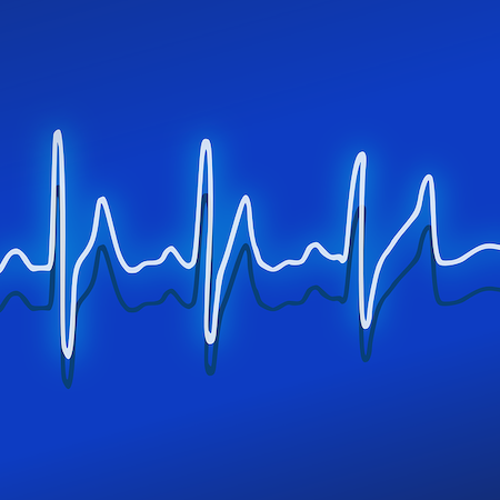 AI-Enabled ECG Helps Identify Heart Failure