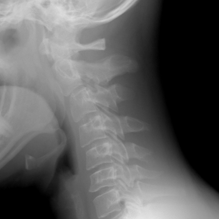 FDA Clears Aidoc's AI Solution for Triage of Cervical Spine Fractures
