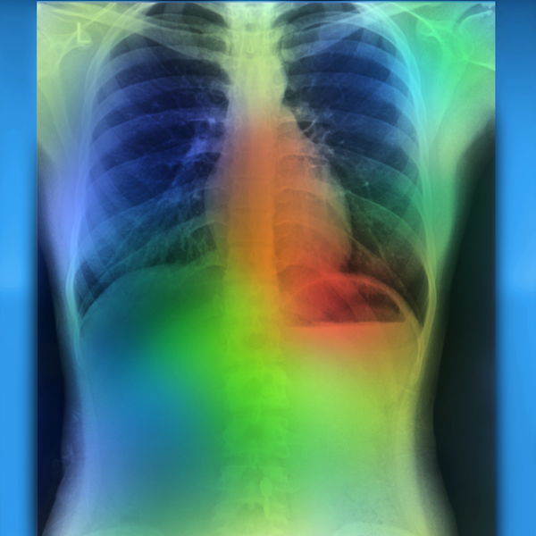AI Accurately Detects Key Findings in Chest X-Rays in 10 Seconds