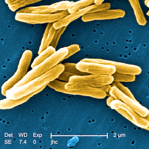 Data Suggest Demise of Tuberculosis Is Slowing. But Tech Offers Hope.