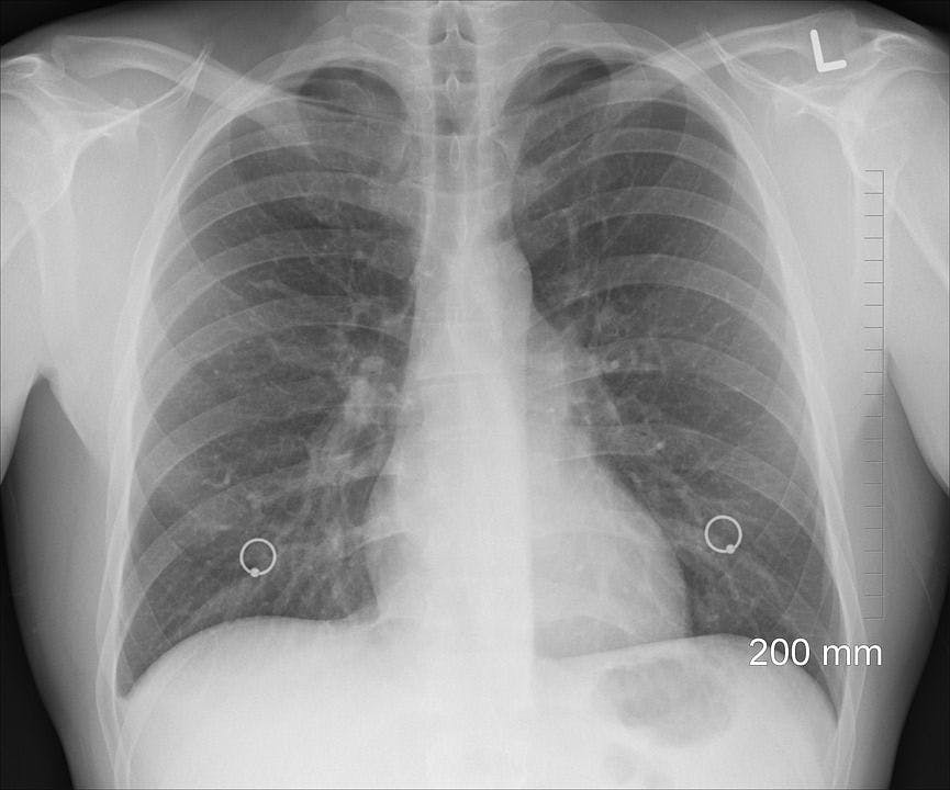How 100K Chest X-Ray Images Could Improve AI and Patient Health