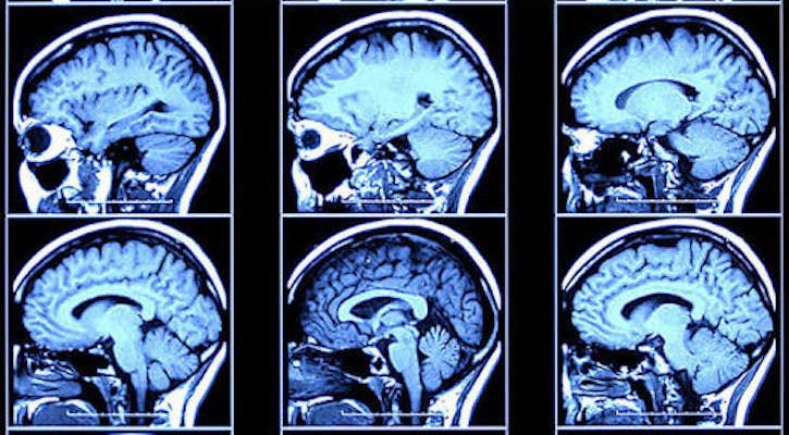 neuroscience,brain imaging,hca news,university of california san francisco,neuroimaging