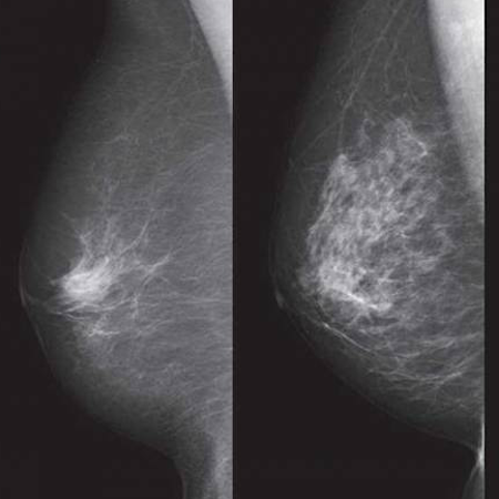 Deep Learning Model Predicts Risk of Breast Cancer Better than Traditional Practice